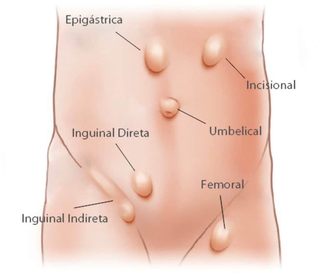 hernia abdominal